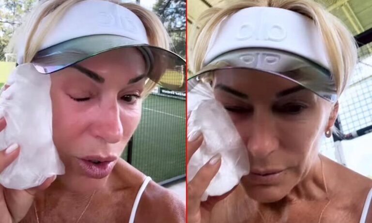 Yanina Latorre sufrió un doloroso accidente en el rostro y sus fotos generaron preocupación