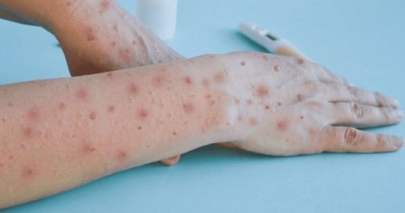 Microscopía del virus de la viruela del mono